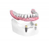 Appareilcomplet sur 2 implants dentaires et 2 boutons – Dentiste Orléans