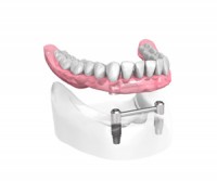Appareilcomplet sur 2 implants dentaires – Dentiste Orléans