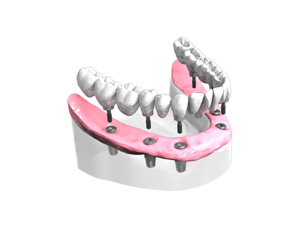 Pose d un bridge complet sur implants dentaires All-on-6 – Dentiste Orléans