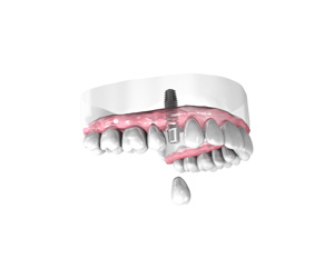 Pose d une couronne dentaire sur implant – Dentiste Orléans